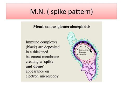 spike and dome appearance|membranous proliferative glomerulonephritis.